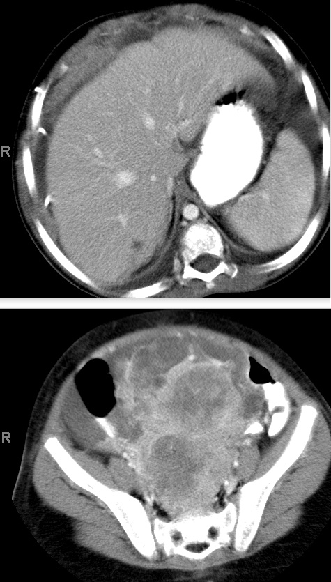 05-18-09Figure76SecondPrimaryCancerCT.jpg 05-18-09Figure76SecondPrimaryCancerCT.jpg